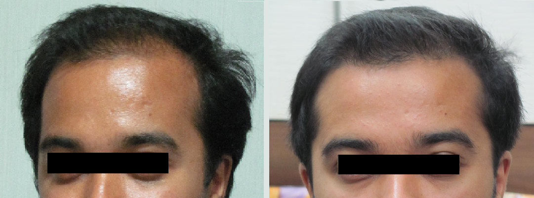hairfall_loss - Before & after