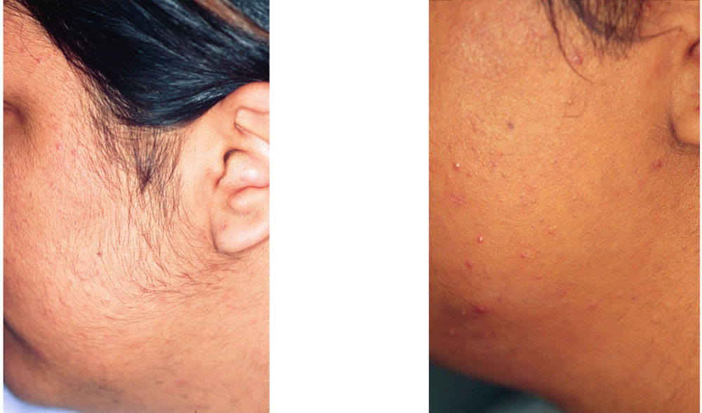 Laser Hair Removal 1 -Before & After