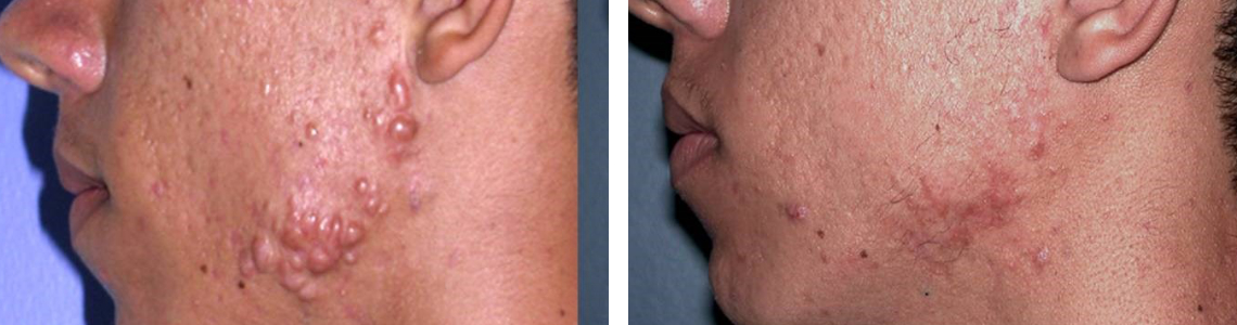 Intralesional injection 1 - Before & After