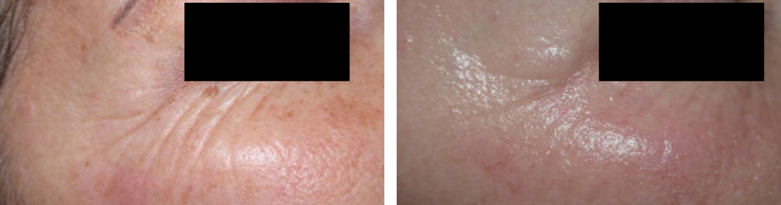 Laser Skin Rejuvenation Image Two