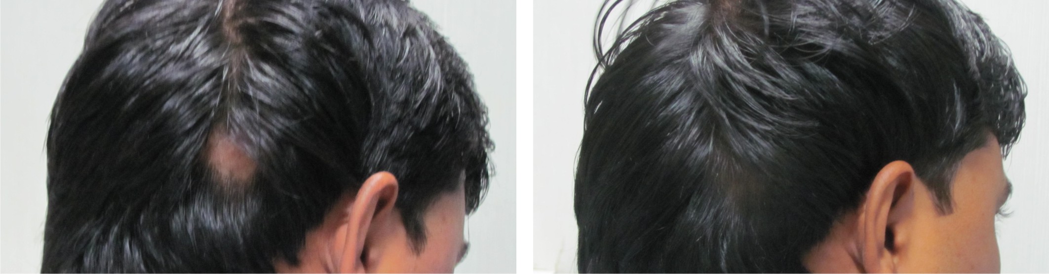 Intralesional Injection Image Five