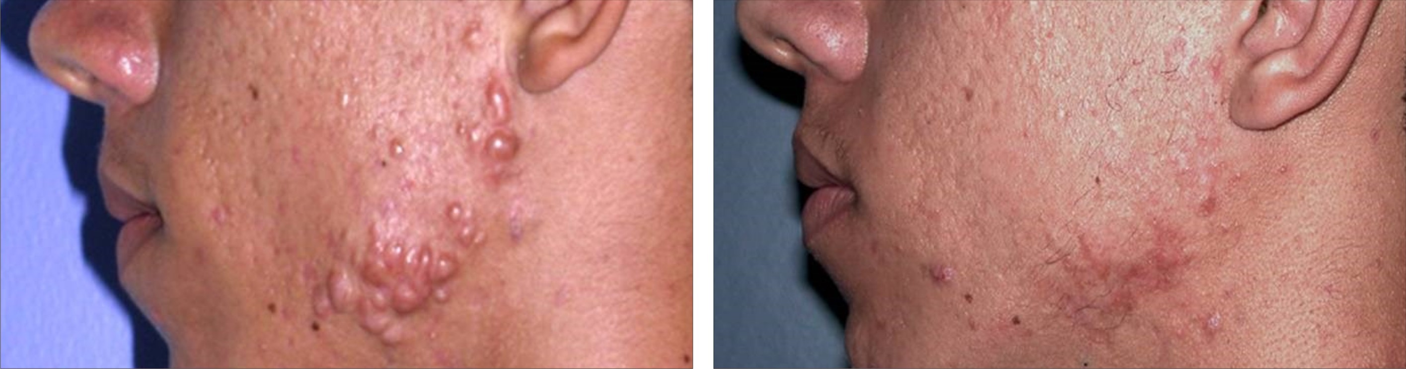 Acne Image Four