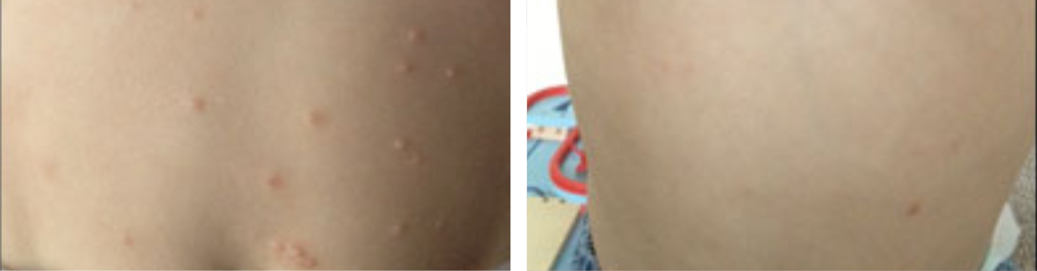 Molluscum Extraction Image Four