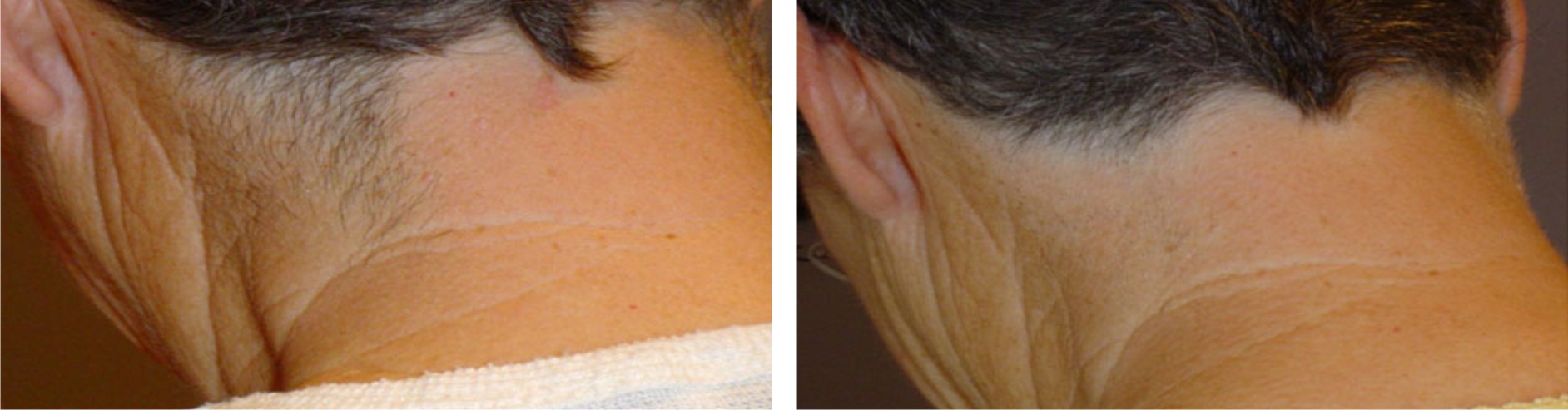Laser Hair Removal Image Two