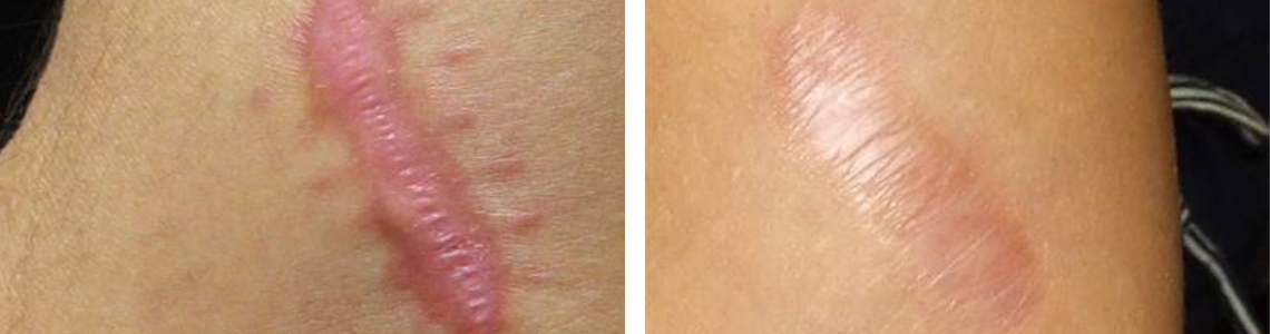 Intralesional injection 4 - Before & After