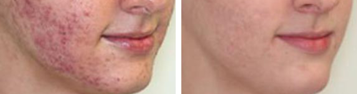 Laser Acne Scar Removal Image Two