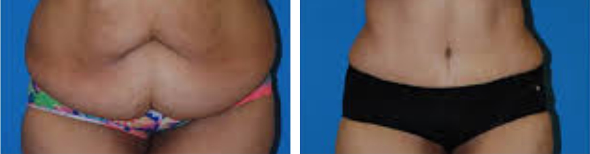 Tummy Tuck Image One