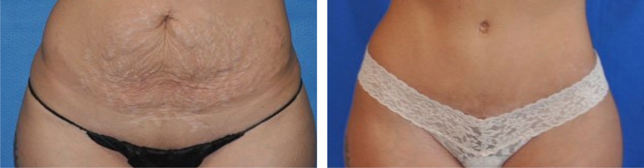 Before & after - Tummy tuck 2