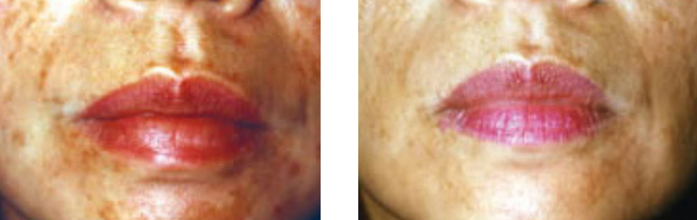 chemical-peel - Before & after