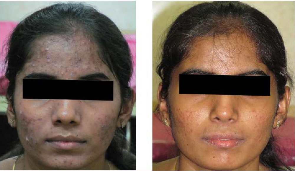 Chemical Peel 3- before & after