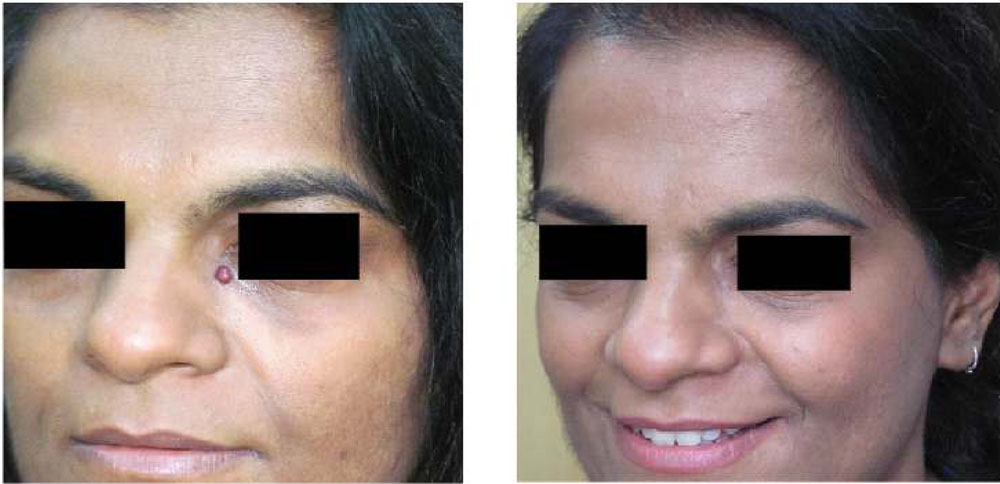 Electrocautery 1 - before & after