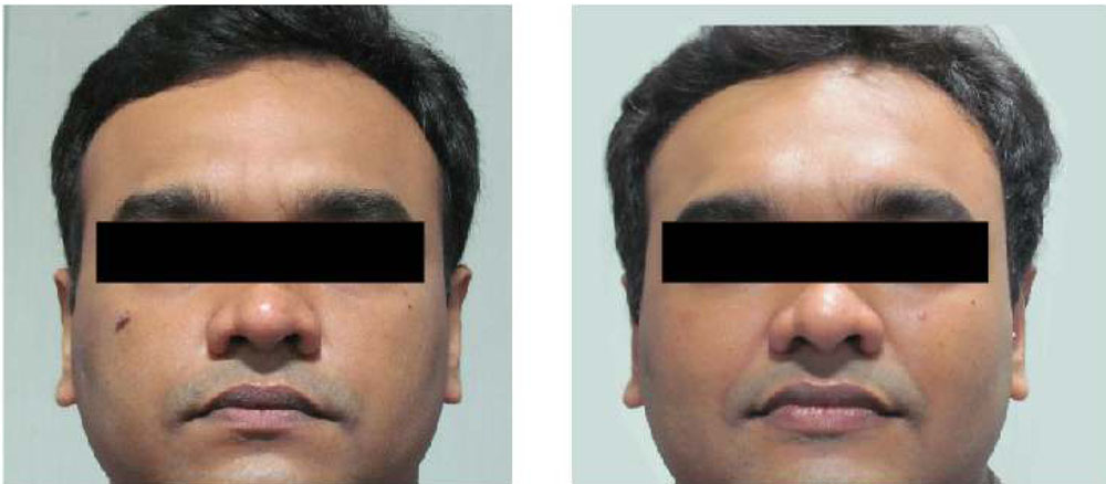 Electrocautery 2 - before & after