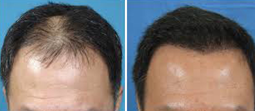 Hair Transplantation 1 - Before & after