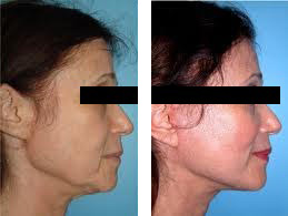Thread Lift 2 - Before & AFter