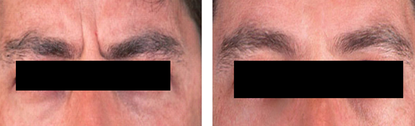 Botulinum Toxin 3- Before & After
