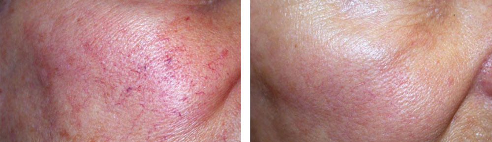 Skin Rejuvenation2 - Before & After