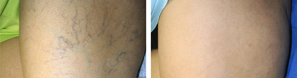 Laser Vein Removal Image One