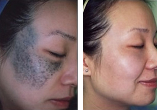 Laser Birthmark Removal 2- Before & After