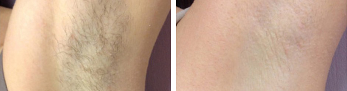 Painless Laser Hair Removal Image Three