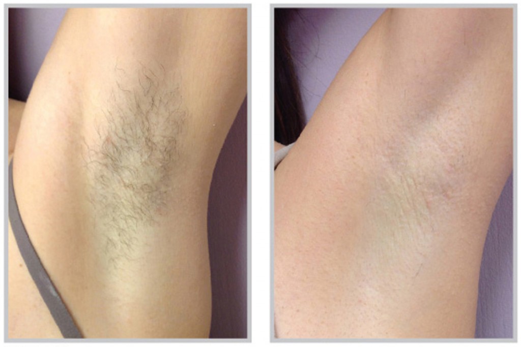 Hair Removal 3 - Before & After