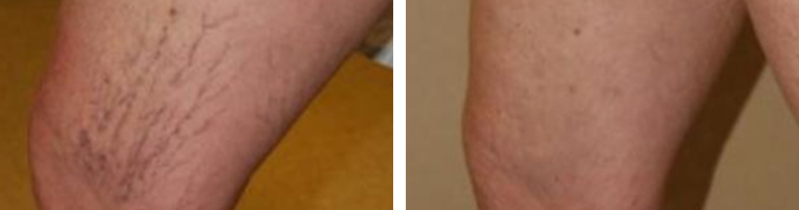 Laser Vein Removal Image Four