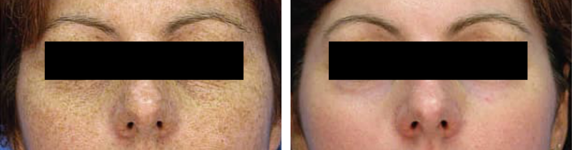 Laser Freckle Removal Image One
