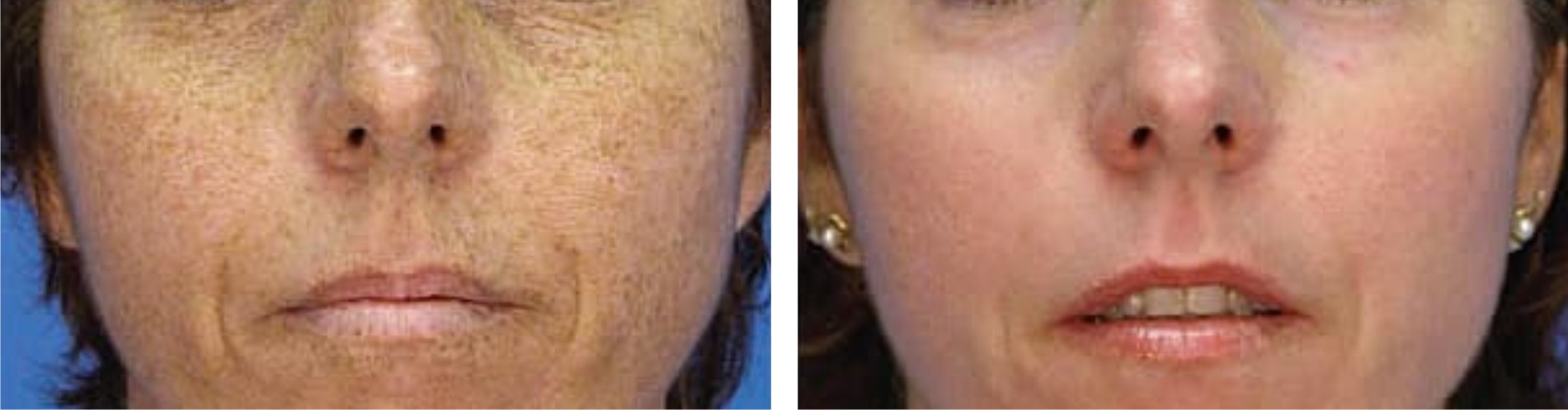 Laser Freckle Removal Image One
