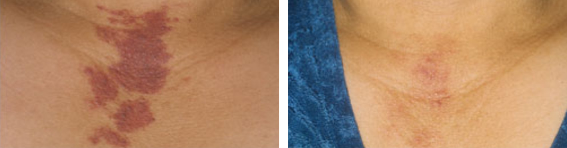 Laser Birthmark Removal Image Three