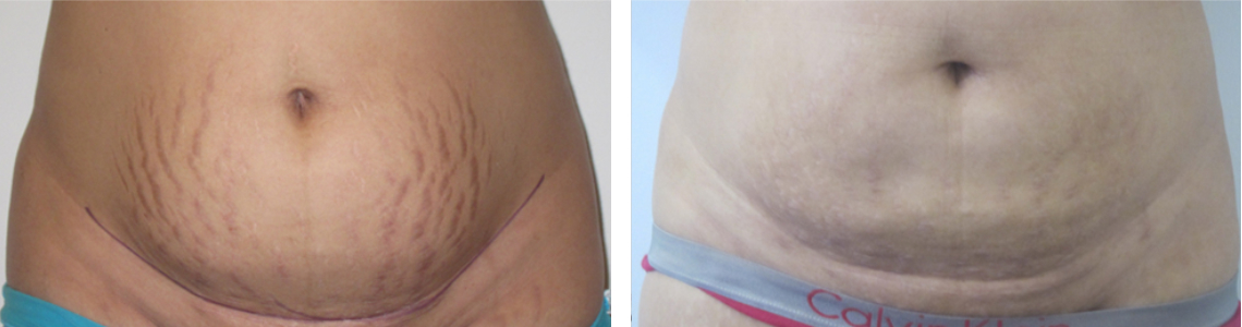 Stretch Marks Image Two