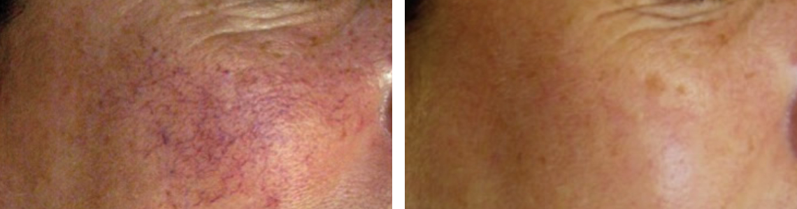 2 laser Broken CapillariesTelangiectases - Before & After