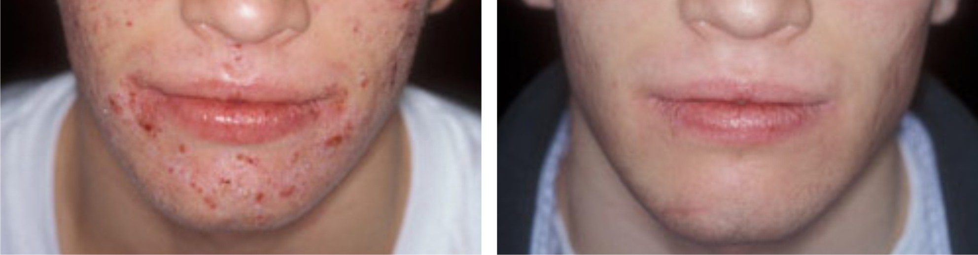 Laser Acne Scar Removal Image Four